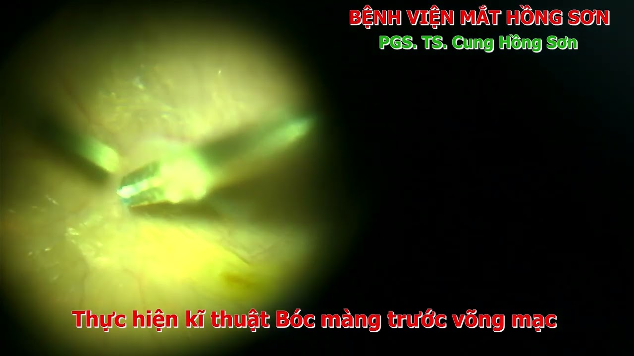 PHẪU THUẬT BÓC MÀNG TRƯỚC VÕNG MẠC - EPIRETINAL MEMBRANE PEELING SURGERY